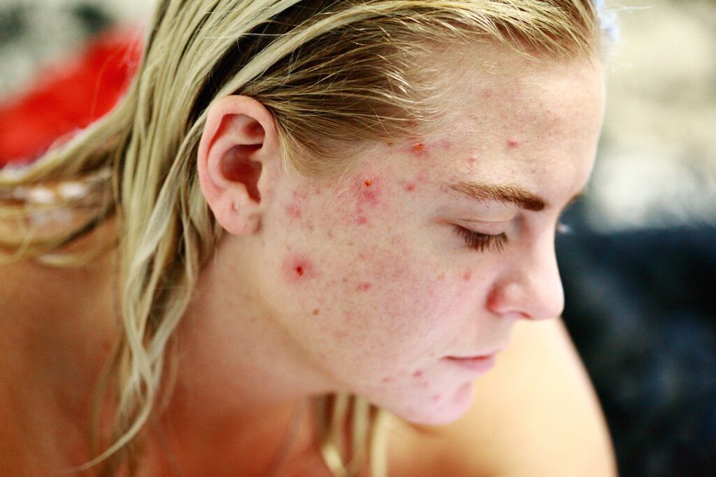 acne on the body and face